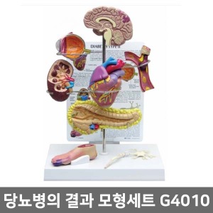 [GPI] G4010 당뇨병의결과 모형세트 ▶당뇨모형세트 당뇨병