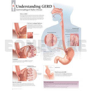 평면해부도(벽걸이) / 1550 /위식도 역류질환 Understanding GERD /사이즈   56cm ⅹ 71cm Paper