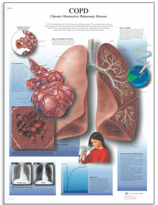 [독일3B] 만성 폐질환차트 COPD차트- Chronic Obstructive Pulmonary Disease VR1329L(코팅) 인체해부도