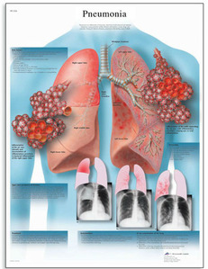 [3B]폐렴차트 감염된폐방사선사진차트 VR1326UU(비코팅) Pneumonia Chart /50 x 67 cm