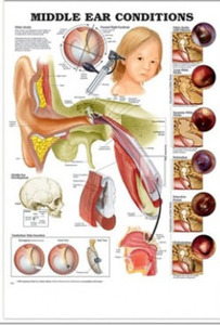 3D해부도(벽걸이)/9893/코차트/( MIDDLE EAR CONDITIONS )