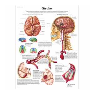 [독일3B] 뇌졸중차트 Stroke Chart VR1627L(코팅) 인체해부도
