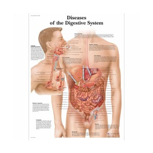 [독일3B] 소화기 질환차트 Diseases of the Digestive System Chart VR1431L(코팅) 인체해부도